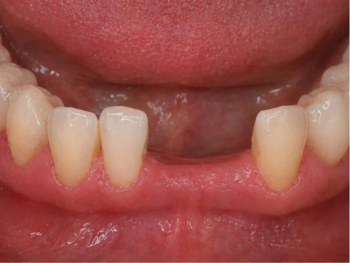Chýbajúce dolné predné zuby — medzera v úsmeve pred použitím Denticor