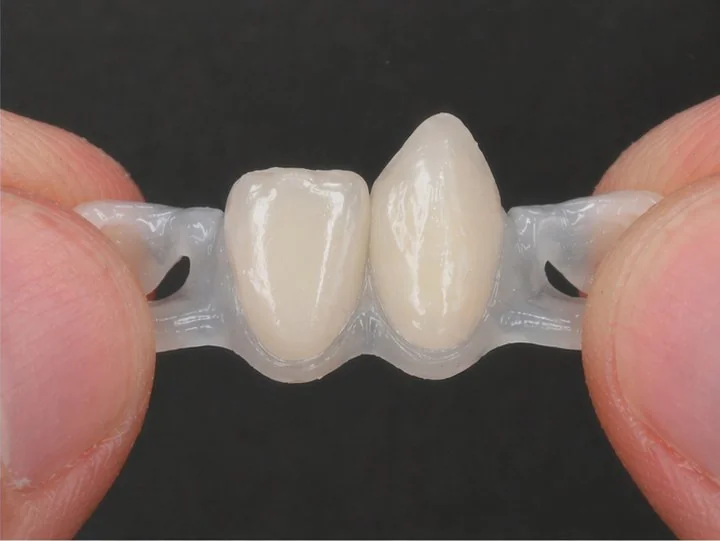 Hotová Denticor náhrada s troma keramickými zubami v tvarovateľnom DentiFlex mostíku