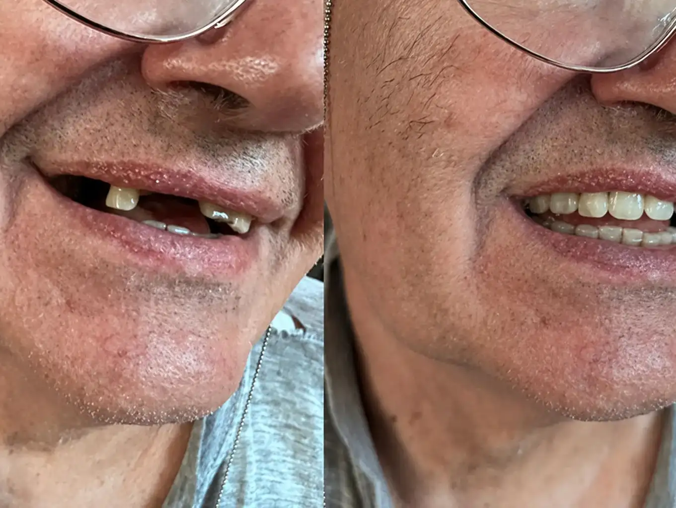 Pred a po — viacero chýbajúcich zubov nahradených Denticorom