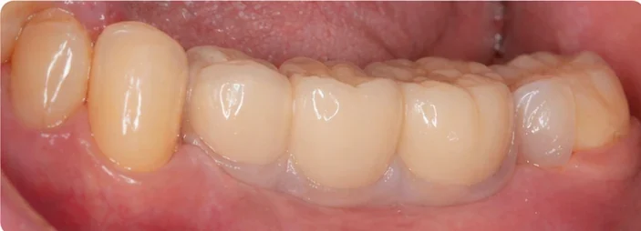 Tri nové zadné zuby Denticor na mieste