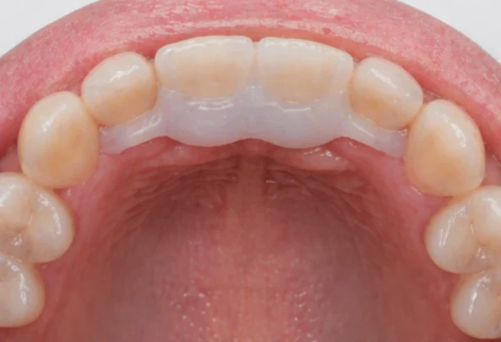 Dva nové predné zuby Denticor na mieste