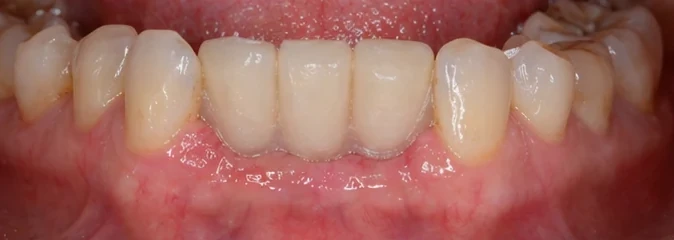 Tri nové dolné predné zuby Denticor na mieste