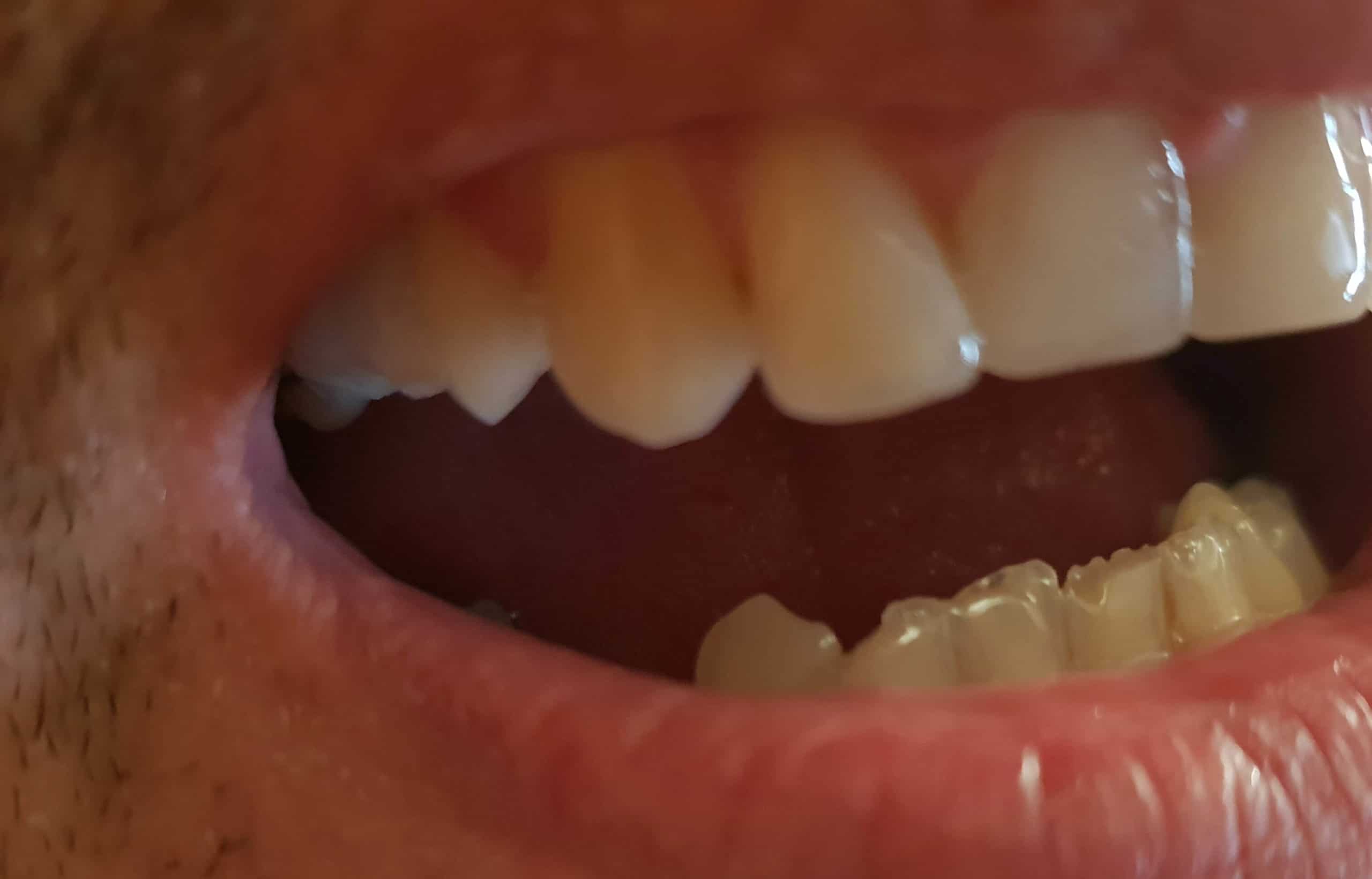 DentiFlex mostík nasadený v ústach — bez koruniek