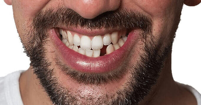 Muž s chýbajúcim predným zubom — reálny scenár, ktorý Denticor rieši doma za 30 minút