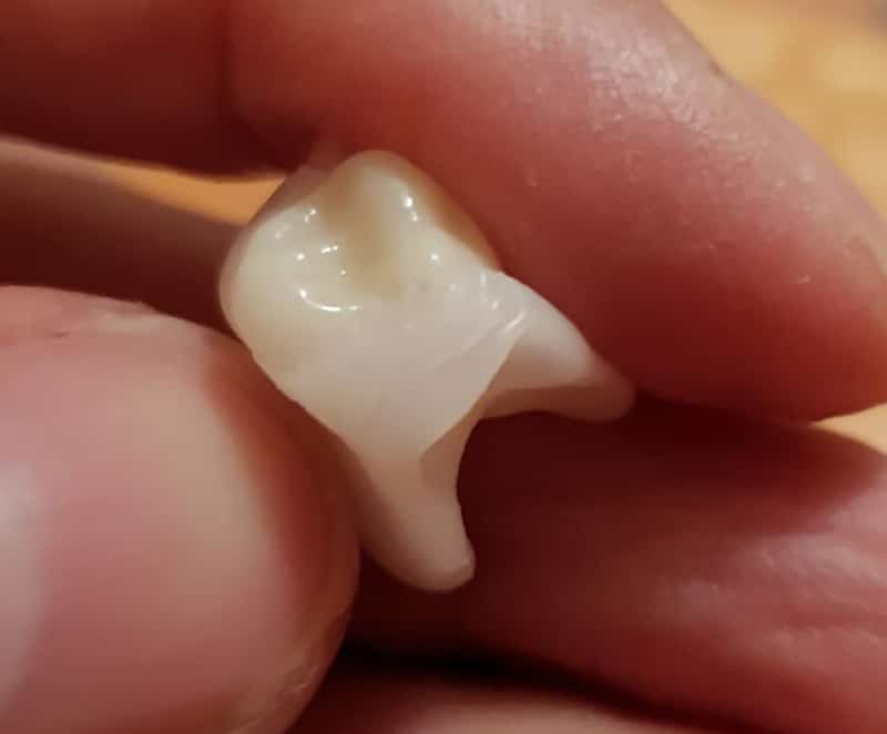 Keramická korunka s DentiFlex mostíkom — makro detail