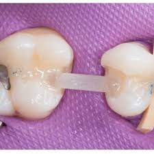 Mostík na sklených vláknach — ilustračná fotka