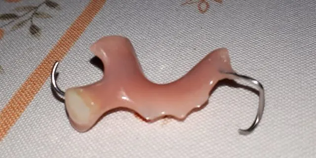 Protéza s kovovými háčikmi — fotka od zákazníka