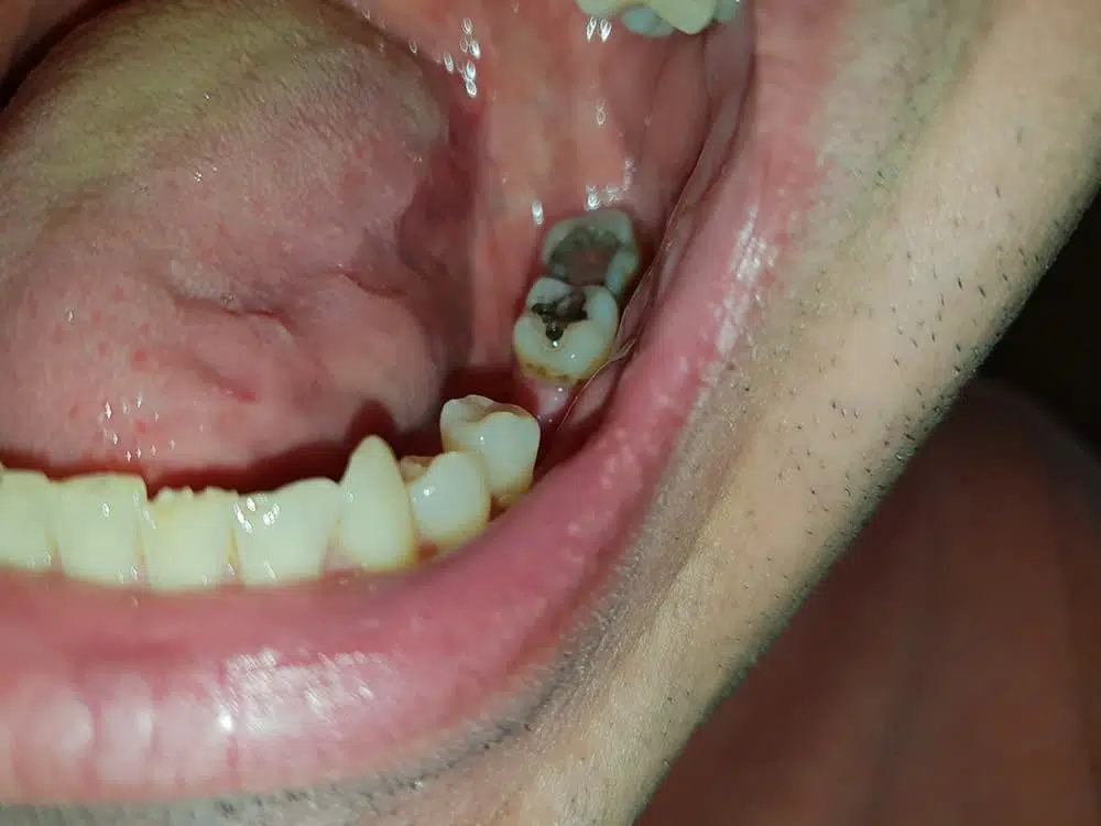 Chýbajúci zub — medzera v zuboch