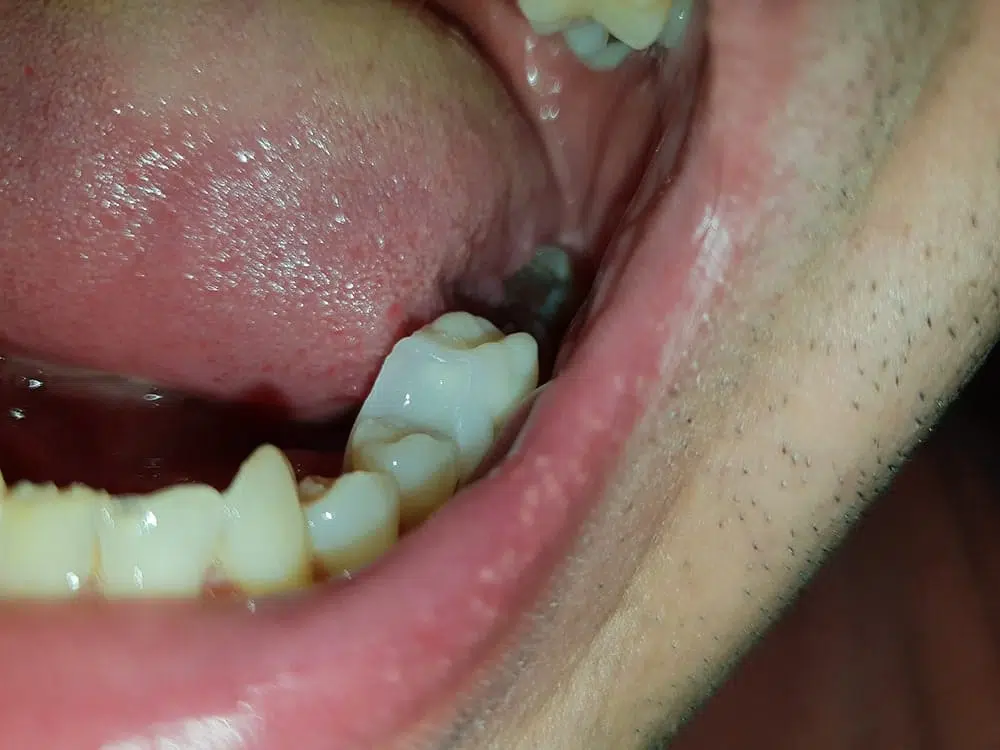 Nasadenie nového zuba Denticor