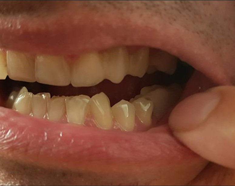 Hotovo — výsledok po nasadení Denticoru