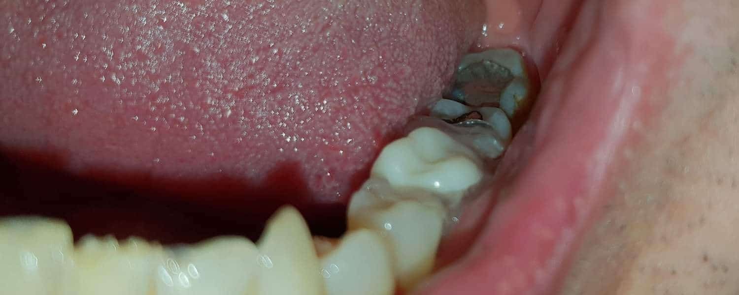 Zub Denticor zblízka medzi vlastnými zubami