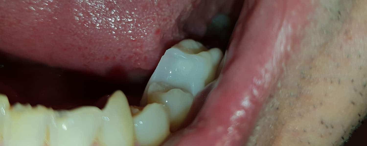 Zub Denticor vložený na miesto chýbajúcej stoličky