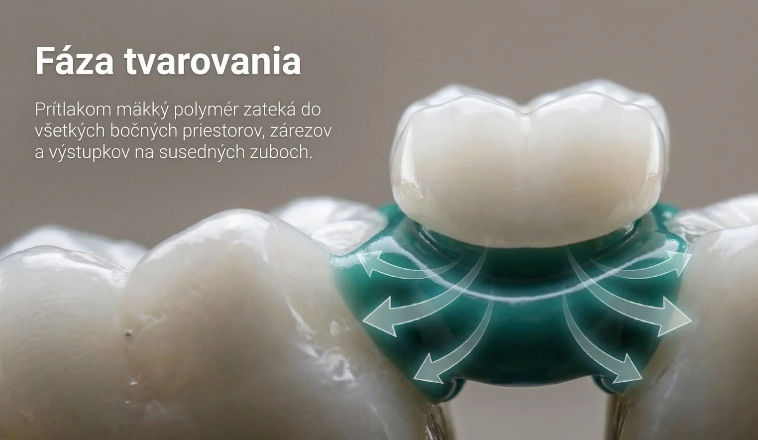 Tvarový zámok — Denticor sedí medzi susednými zubmi, nedotýka sa rany po extrakcii
