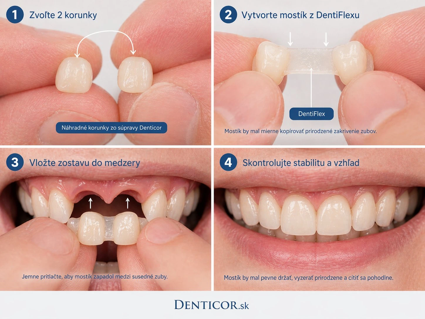 Postup Denticor pri chýbajúcich dvoch zuboch — výber dvoch koruniek, vytvorenie spoločného mostíka, vloženie a kontrola