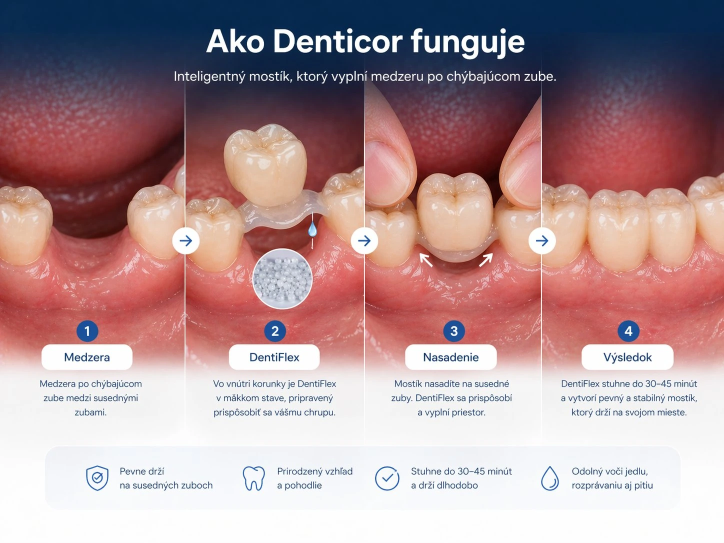 Ako Denticor funguje — inteligentný mostík, ktorý vyplní medzeru po chýbajúcom zube. Štyri kroky: medzera, DentiFlex, nasadenie, výsledok. Pevne drží, prirodzený vzhľad, stuhne do 30 až 45 minút, odolný voči jedlu, rozprávaniu aj pitiu.
