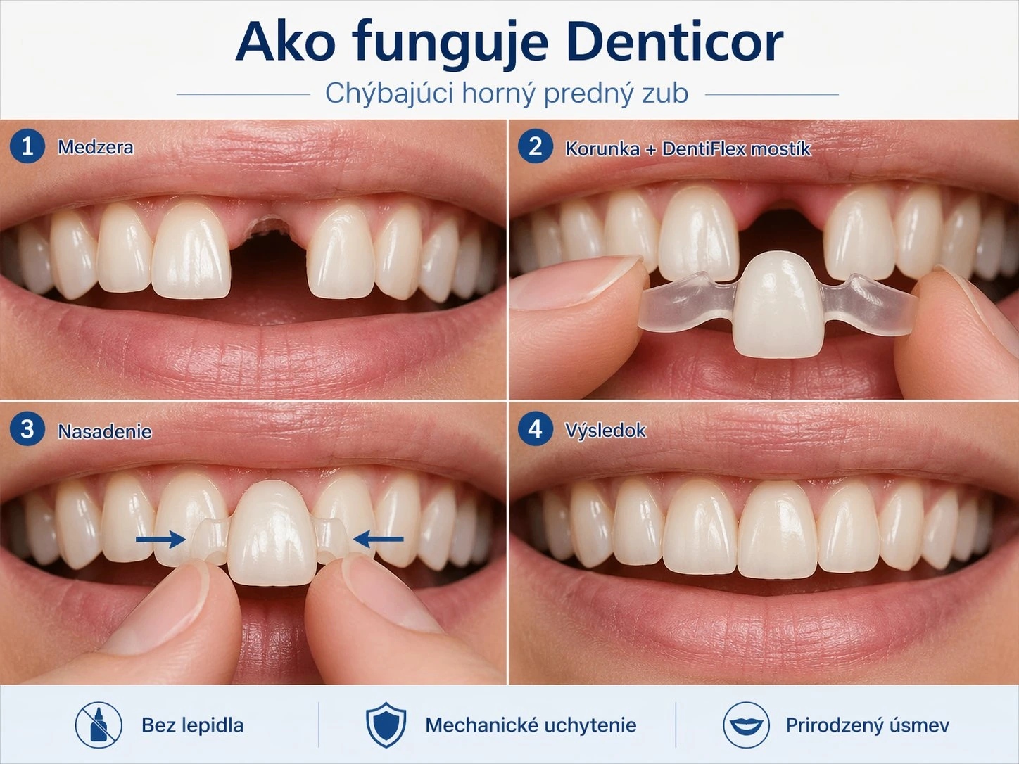 Ako funguje Denticor pri chýbajúcom hornom prednom zube — medzera, korunka v DentiFlex mostíku, nasadenie, výsledok