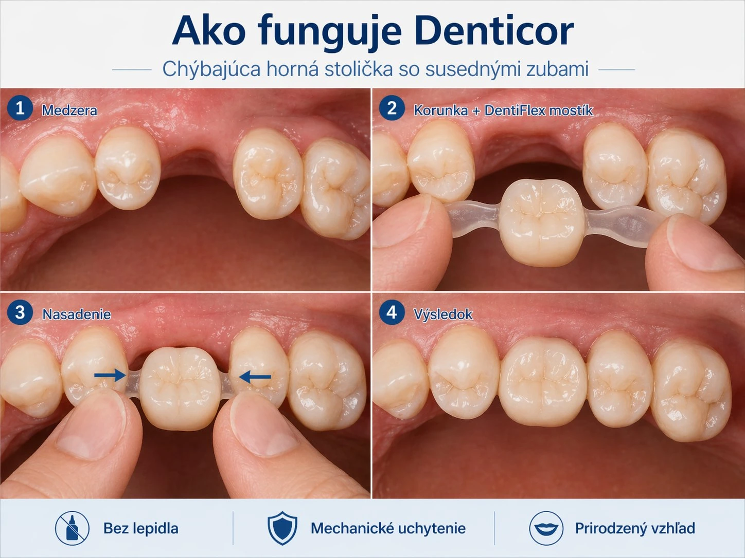 Ako funguje Denticor pri chýbajúcej hornej stoličke so susednými zubami — postup v štyroch krokoch