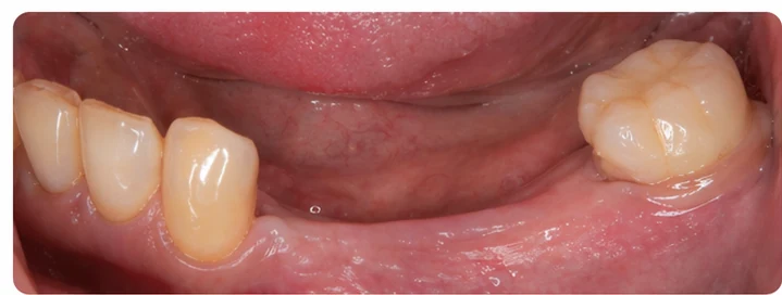 Vizuálny postup pre tri zadné zuby dole – princíp vloženia Denticor mostíka s novými zubami a jeho dotvarovania o okolité zuby