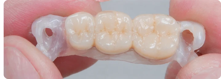 Vizuálny postup pre tri zadné zuby dole – princíp vloženia Denticor mostíka s novými zubami a jeho dotvarovania o okolité zuby