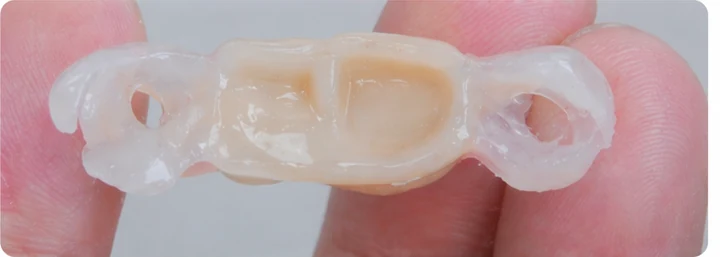 Vizuálny postup pre tri zadné zuby dole – princíp vloženia Denticor mostíka s novými zubami a jeho dotvarovania o okolité zuby