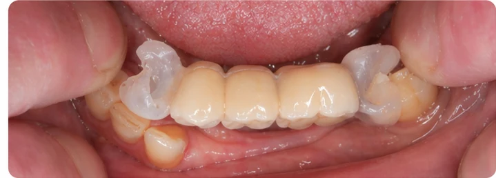 Vizuálny postup pre tri zadné zuby dole – princíp vloženia Denticor mostíka s novými zubami a jeho dotvarovania o okolité zuby