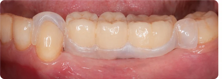 Vizuálny postup pre tri zadné zuby dole – princíp vloženia Denticor mostíka s novými zubami a jeho dotvarovania o okolité zuby