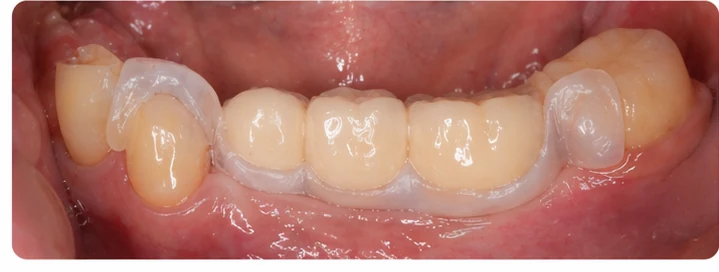 Vizuálny postup pre tri zadné zuby dole – princíp vloženia Denticor mostíka s novými zubami a jeho dotvarovania o okolité zuby