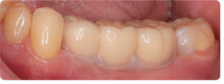 Vizuálny postup pre tri zadné zuby dole – princíp vloženia Denticor mostíka s novými zubami a jeho dotvarovania o okolité zuby