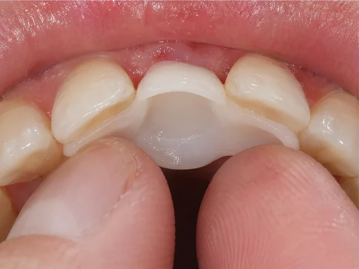 Vkladanie z vnútornej strany — DentiFlex sa pritláča okolo susedných zubov a vytvára zámok zozadu