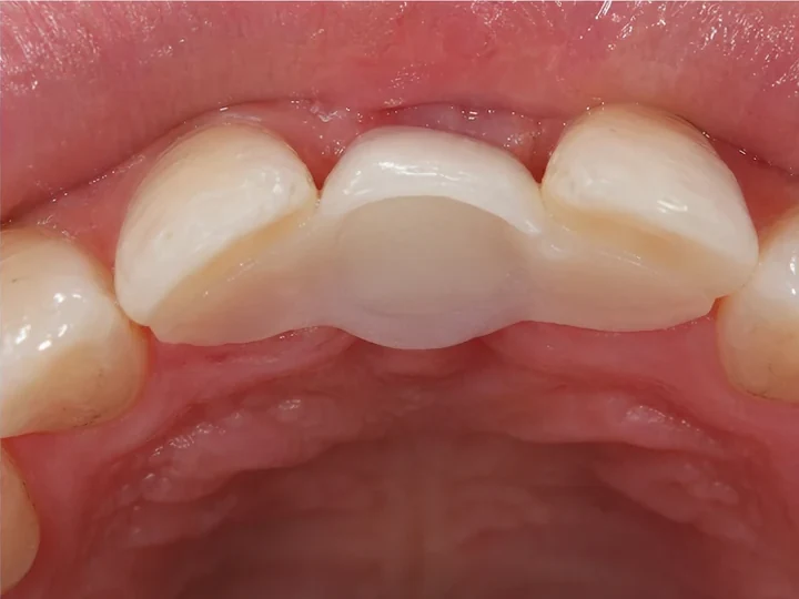 Výsledný zámok zozadu — DentiFlex obopína vnútornú stranu susedných zubov a drží korunku mechanicky