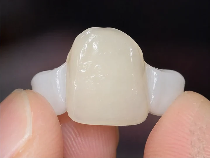 Fazety pre estetické zakrytie predných zubov