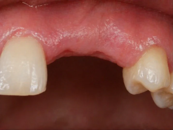 Chýbajúci horný bočný rezák a očný zub – medzera v úsmeve pred použitím Denticor