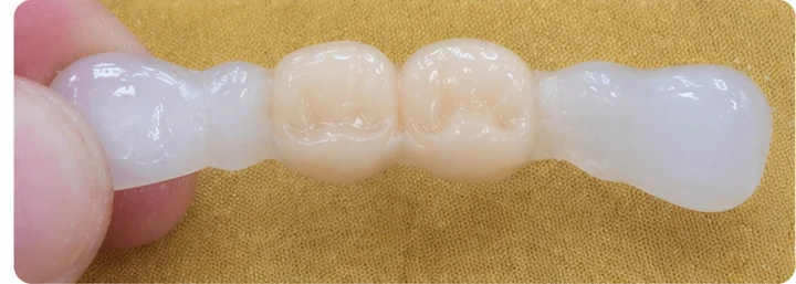 Vizuálny postup pre očný zub a dva premoláre hore – princíp vloženia Denticor mostíka s novými zubami a jeho dotvarovania o okolité zuby
