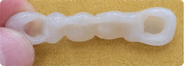 Vizuálny postup pre očný zub a dva premoláre hore – princíp vloženia Denticor mostíka s novými zubami a jeho dotvarovania o okolité zuby