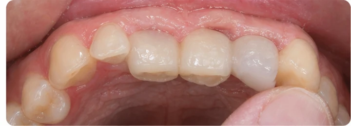 Vizuálny postup pre očný zub a dva premoláre hore – princíp vloženia Denticor mostíka s novými zubami a jeho dotvarovania o okolité zuby