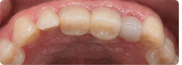 Vizuálny postup pre očný zub a dva premoláre hore – princíp vloženia Denticor mostíka s novými zubami a jeho dotvarovania o okolité zuby
