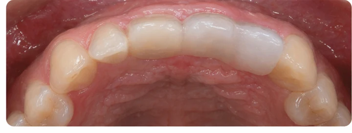 Vizuálny postup pre očný zub a dva premoláre hore – princíp vloženia Denticor mostíka s novými zubami a jeho dotvarovania o okolité zuby