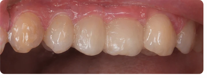 Vizuálny postup pre očný zub a dva premoláre hore – princíp vloženia Denticor mostíka s novými zubami a jeho dotvarovania o okolité zuby