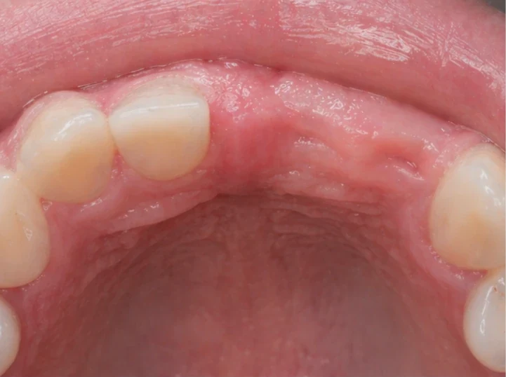 Denticor pre horný stredný a bočný rezák – pohľad zozadu od podnebia: tvar mostíka a dosadnutie za novými zubami