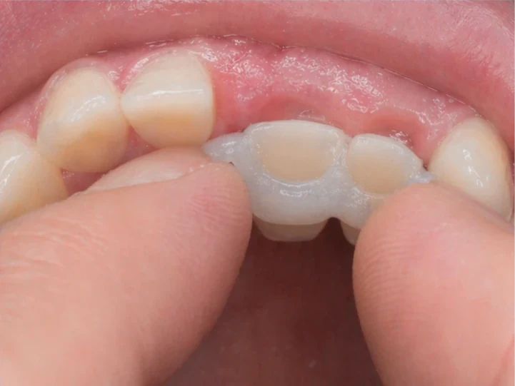 Denticor pre horný stredný a bočný rezák – pohľad zozadu od podnebia: tvar mostíka a dosadnutie za novými zubami