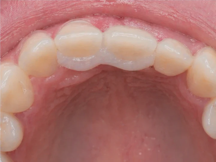 Denticor pre horný stredný a bočný rezák – pohľad zozadu od podnebia: tvar mostíka a dosadnutie za novými zubami