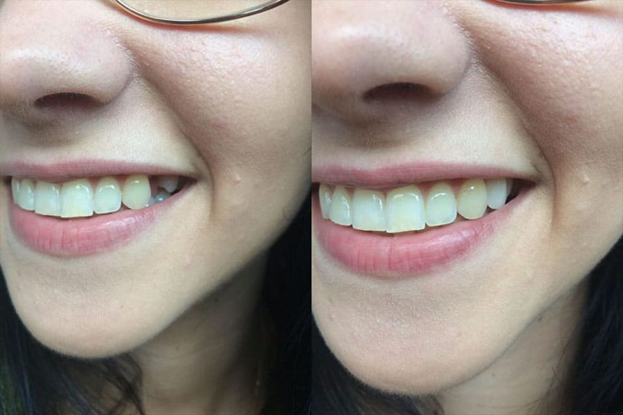 Pred a po nasadení Denticoru — chýbajúci horný predný zub vyriešený doma