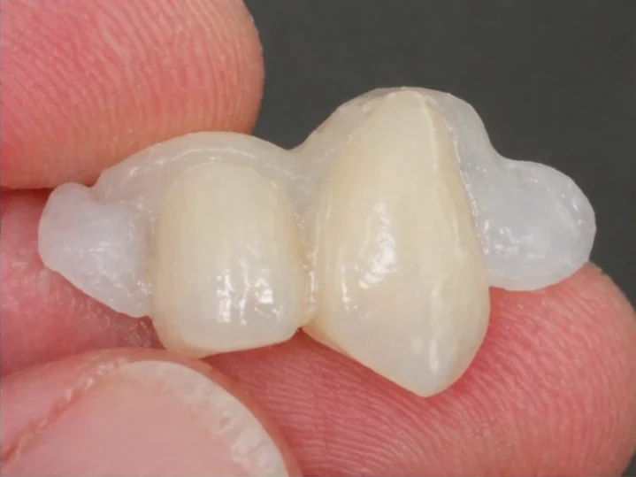 Hotová náhrada Denticor pre chýbajúce horné bočné zuby