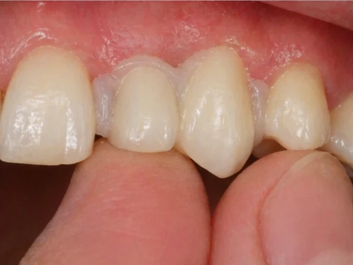 Výsledok po nasadení náhrady Denticor do hornej bočnej medzery