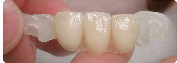 Hotová náhrada Denticor pre viac spodných predných zubov