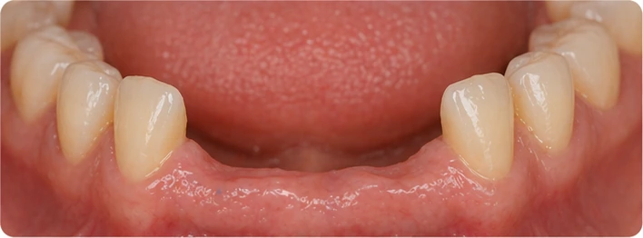 Medzera po chýbajúcich spodných predných zuboch pred použitím Denticor