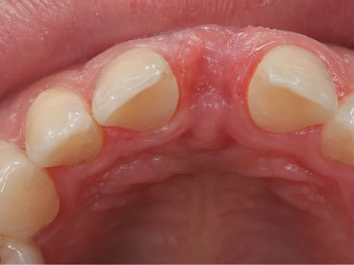 Medzera po jednom chýbajúcom hornom prednom zube pred nasadením Denticor