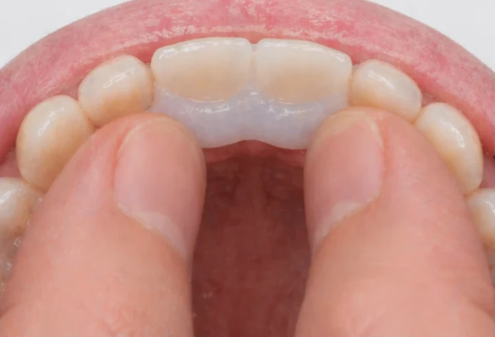 Výsledok po nasadení náhrady Denticor na dva horné predné zuby