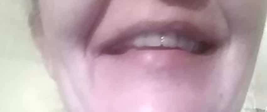 Zákazníčka — chýbajúci zub doplnený a zlomený zub opravený Denticorom