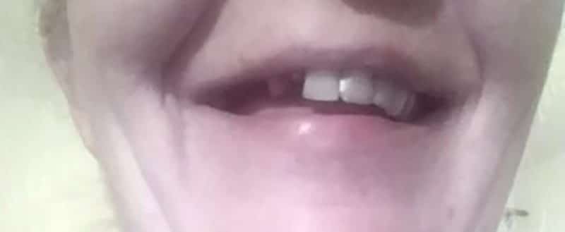 Zákazníčka — chýbajúci predný zub a vedľajší zlomený, pred Denticorom